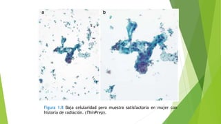 Figura 1.8 Baja celularidad pero muestra satisfactoria en mujer con
historia de radiación. (ThinPrep).
 