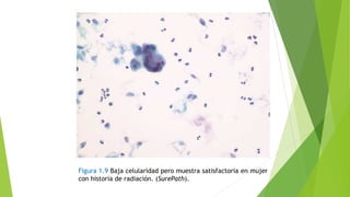Figura 1.9 Baja celularidad pero muestra satisfactoria en mujer
con historia de radiación. (SurePath).
 