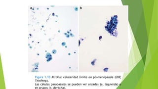 Figura 1.10 Atrofia: celularidad límite en posmenopausia (LBP,
ThinPrep).
Las células parabasales se pueden ver aisladas (a, izquierda) o
en grupos (b, derecha).
 