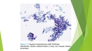 Figura 1.11 Muestra insatisfactoria (LBP, ThinPrep).
Abundantes células endocervicales y moco con escasas células
escamosas
 