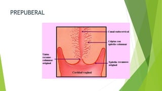 PREPUBERAL
 