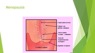 Menopausia
 