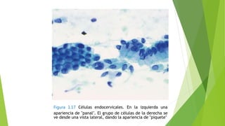 Figura 1.17 Células endocervicales. En la izquierda una
apariencia de "panal". El grupo de células de la derecha se
ve desde una vista lateral, dando la apariencia de "piquete"
 