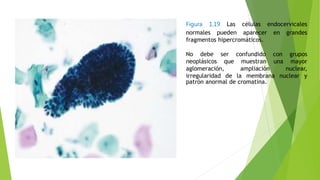 Figura 1.19 Las células endocervicales
normales pueden aparecer en grandes
fragmentos hipercromáticos.
No debe ser confundido con grupos
neoplásicos que muestran una mayor
aglomeración, ampliación nuclear,
irregularidad de la membrana nuclear y
patrón anormal de cromatina.
 