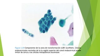 Figura 1.20 Componente de la zona de transformación (LBP, SurePath). Células
endocervicales normales de la la región superior del canal endocervical puede
imitar de cerca a las células metaplásicas escamosas
 