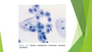 Figura 1.21 Células metaplásicas escamosas normales
(SurePath)
 