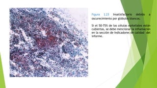 Figura 1.23 Insatisfactorio debido a
oscurecimiento por glóbulos blancos.
Si el 50-75% de las células epiteliales están
cubiertas, se debe mencionar la inflamación
en la sección de Indicadores de calidad del
informe.
 