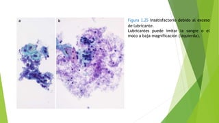 Figura 1.25 Insatisfactorio debido al exceso
de lubricante.
Lubricantes puede imitar la sangre o el
moco a baja magnificación (izquierda).
 