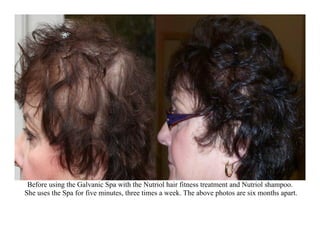 Before using the Galvanic Spa with the Nutriol hair fitness treatment and Nutriol shampoo.
She uses the Spa for five minutes, three times a week. The above photos are six months apart.
 