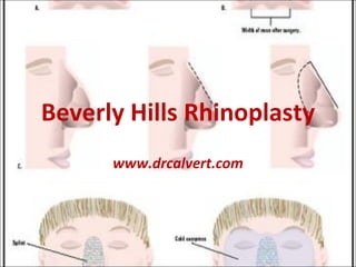 Beverly Hills Rhinoplasty www.drcalvert.com 