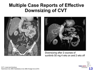 Multiple Case Reports of Effective Downsizing of CVT  Prior to sunitinib After 2 cycles of sunitinib Downsizing after 2 courses of  sunitinib 50 mg 4 wks on and 2 wks off CVT = caval vein thrombus. Harshman et al, 2009; Karakiewicz et al, 2008; Kroeger et al, 2010. 
