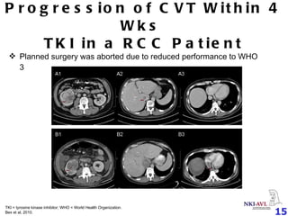 Progression of CVT Within 4 Wks  TKI in a RCC Patient Planned surgery was aborted due to reduced performance to WHO 3 TKI = tyrosine kinase inhibitor; WHO =  World Health Organization. Bex et al, 2010.  