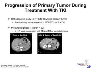 Progression of Primary Tumor During Treatment With TKI Retrospective study (n = 19) to downsize primary tumor Local primary tumor progression (RECIST); n = 9 (47%) Presurgical phase II trial (n = 22)  n = 2; local progression with SD and PR at metastatic sites Prior to Sunitinib After 2 Cycles of Sunitinib SD = stable disease; PR = partial response. Thomas, Rini, Lane, et al, 2009; Powles et al, 2011. 