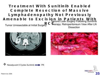 Neoadjuvant 5 Cycles Sunitinib  PR Treatment With Sunitinib Enabled Complete Resection of Massive Lymphadenopathy Not Previously Amenable to Excision in Patients With RCC Patard et al, 2009. Tumor Unresectable at Initial Surgery Second Look Surgery Following Sunitinib Therapy: Retroperitoneum View After LN Dissection 