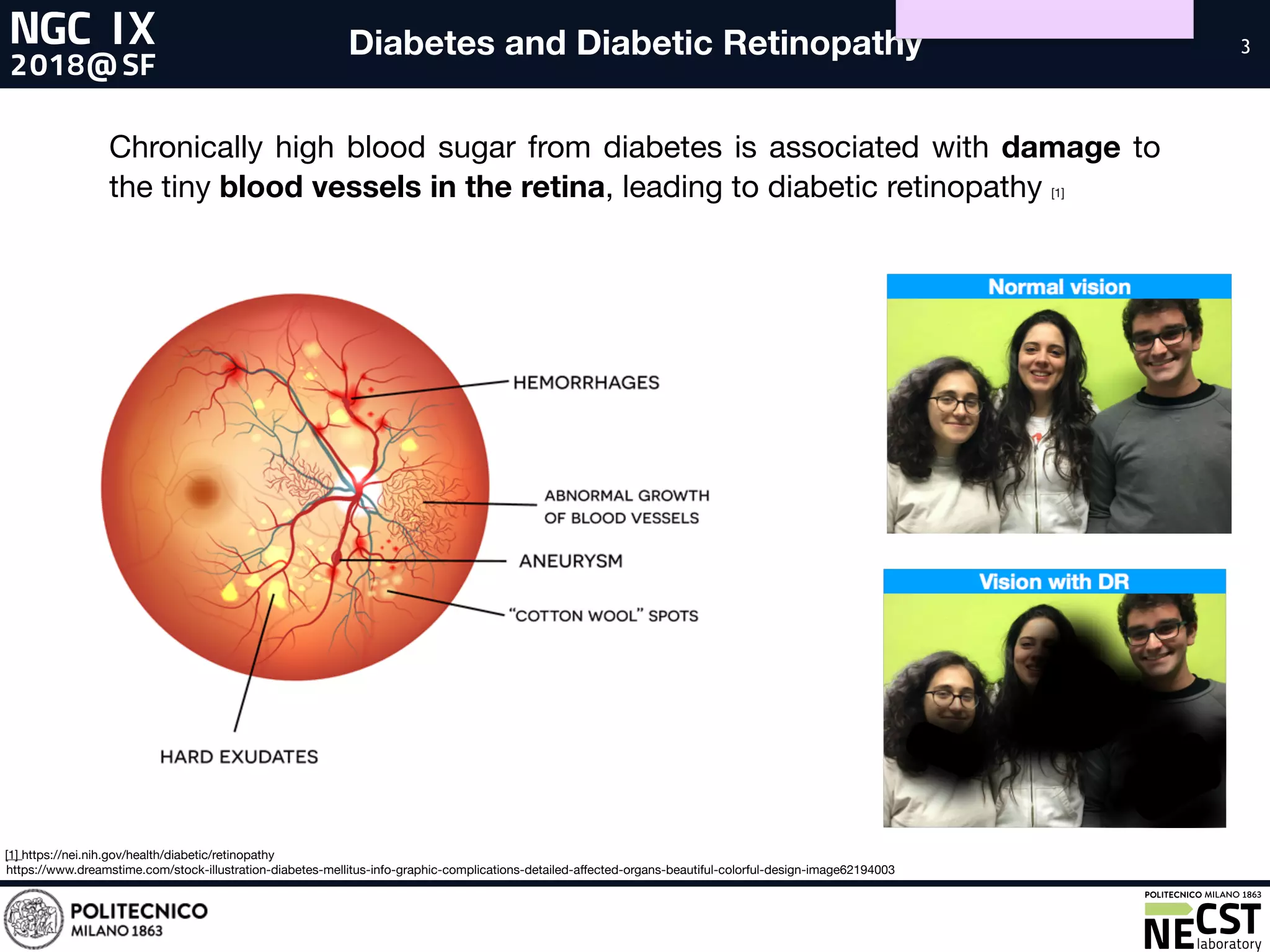 3
Chronically high blood sugar from diabetes is associated with damage to
the tiny blood vessels in the retina, leading to diabetic retinopathy [1]
[1] https://nei.nih.gov/health/diabetic/retinopathy
Diabetes and Diabetic Retinopathy
https://www.dreamstime.com/stock-illustration-diabetes-mellitus-info-graphic-complications-detailed-affected-organs-beautiful-colorful-design-image62194003
 