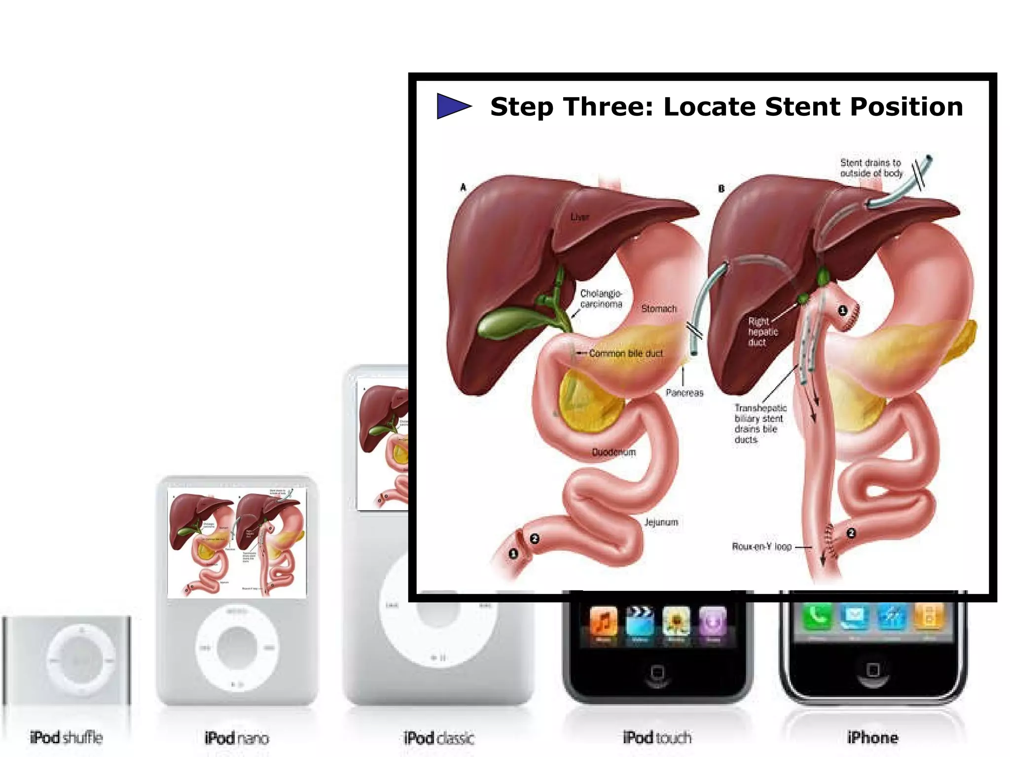 Step Three: Locate Stent Position 