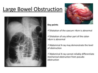 Large Bowel Obstruction
Key points
Dilatation of the caecum >9cm is abnormal
Dilatation of any other part of the colon
>6cm is abnormal
Abdominal X-ray may demonstrate the level
of obstruction
Abdominal X-ray cannot reliably differentiate
mechanical obstruction from pseudo-
obstruction
 