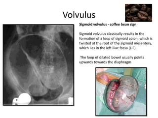 Volvulus
Sigmoid volvulus - coffee bean sign
Sigmoid volvulus classically results in the
formation of a loop of sigmoid colon, which is
twisted at the root of the sigmoid mesentery,
which lies in the left iliac fossa (LIF).
The loop of dilated bowel usually points
upwards towards the diaphragm
 