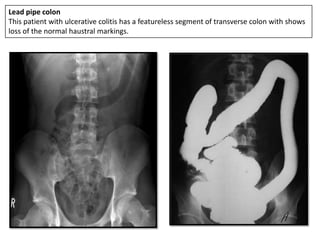 Lead pipe colon
This patient with ulcerative colitis has a featureless segment of transverse colon with shows
loss of the normal haustral markings.
 