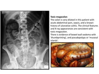Toxic megacolon
The colon is very dilated in this patient with
acute abdominal pain, sepsis, and a known
history of ulcerative colitis. The clinical features
and X-ray appearances are consistent with
toxic megacolon.
There is evidence of bowel wall oedema with
'thumbprinting', and pseudopolyps or 'mucosal
islands'.
 