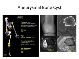 Aneurysmal Bone Cyst
 