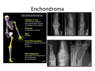 Enchondroma
 