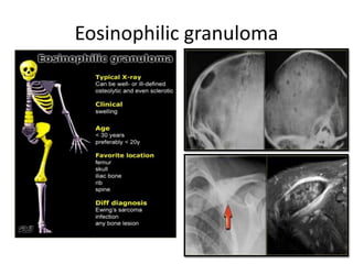 Eosinophilic granuloma
 
