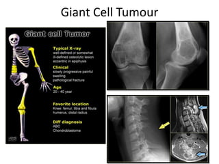 Giant Cell Tumour
 