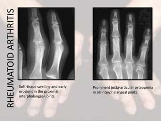 Soft-tissue swelling and early
erosions in the proximal
interphalangeal joints
Prominent juxta-articular osteopenia
in all interphalangeal joints
RHEUMATOIDARTHRITIS
 