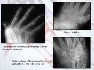 Subluxation in the metacarpophalangeal joints,
with ulnar deviation
Marked ankylosis
Partial collapse of fused carpal bones with
subluxation at the radiocarpal joint
 