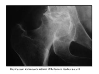 Osteonecrosis and complete collapse of the femoral head are present
 