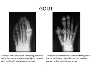 GOUT
Sclerosis and joint-space narrowing are seen
in the first metatarsophalangeal joint, as well
as in the fourth interphalangeal joint
Extensive bony erosions are noted throughout
the carpal bones. Urate depositions may be
present in the periarticular areas.
 