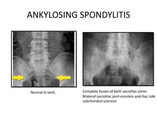ANKYLOSING SPONDYLITIS
Bilateral sacroiliac joint erosions and iliac side
subchondral sclerosis
Complete fusion of both sacroiliac jointsNormal SI Joint.
 