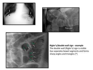 Rigler's/double wall sign - example
The double wall (Rigler's) sign is visible
Gas separates bowel segments and forms
sharp angles and triangles (*)
 