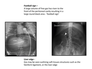 Football sign –
A large volume of free gas has risen to the
front of the peritoneal cavity resulting in a
large round black area - 'football sign‘
Liver edge -
Gas may be seen outlining soft tissues structures such as the
falciform ligament, or the liver edge
 