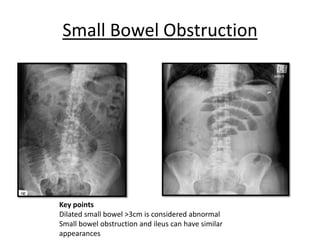 Small Bowel Obstruction
Key points
Dilated small bowel >3cm is considered abnormal
Small bowel obstruction and ileus can have similar
appearances
 