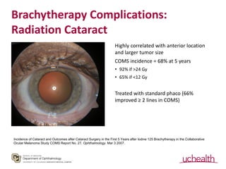 Brachytherapy Complications:
Radiation Cataract
Highly correlated with anterior location
and larger tumor size
COMS incide...