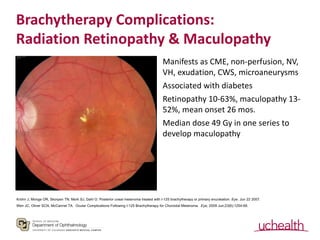 Brachytherapy Complications:
Radiation Retinopathy & Maculopathy
Manifests as CME, non-perfusion, NV,
VH, exudation, CWS, ...
