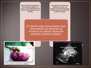 Esto favorece el retardo de
la evacuación gástrica, lo
que a su vez determina una
mayor deshidratación de la
mezcla.

Si el bezoar en formación
traspone el píloro, se
mezcla con las secreciones,
biliopacreáticas y determina
cuadros ocluidos.

En las fórmulas concentradas para
alimentación de lactantes se
involucra la posición dorsal del
paciente durante la ingesta.

 