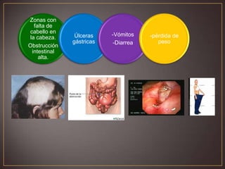 Zonas con
falta de
cabello en
la cabeza.
Obstrucción
intestinal
alta.

Úlceras
gástricas

-Vómitos
-Diarrea

-pérdida de
peso

 