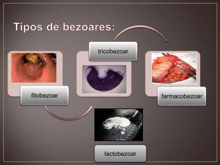 tricobezoar

fitobezoar

farmacobezoar

lactobezoar

 