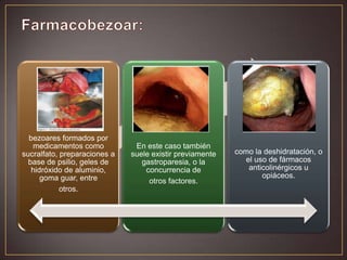 bezoares formados por
medicamentos como
sucralfato, preparaciones a
base de psilio, geles de
hidróxido de aluminio,
goma guar, entre
otros.

En este caso también
suele existir previamente
gastroparesia, o la
concurrencia de
otros factores.

como la deshidratación, o
el uso de fármacos
anticolinérgicos u
opiáceos.

 