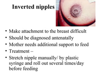 Inverted nipples
• Make attachment to the breast difficult
• Should be diagnosed antenatally
• Mother needs additional support to feed
• Treatment –
• Stretch nipple manually/ by plastic
syringe and roll out several times/day
before feeding
 