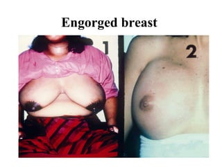 Engorged breast
 