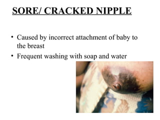 SORE/ CRACKED NIPPLE
• Caused by incorrect attachment of baby to
the breast
• Frequent washing with soap and water
 