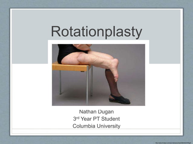 Rotationplasty | PPTX