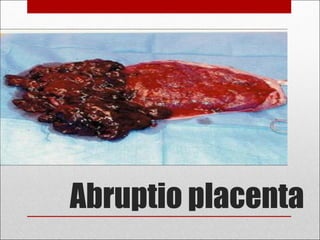 Abruptio placenta
 