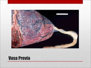 Vasa Previa
 