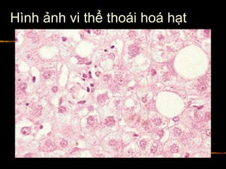 Hình ảnh vi thể thoái hoá hạt
 