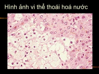 Hình ảnh vi thể thoái hoá nước
 